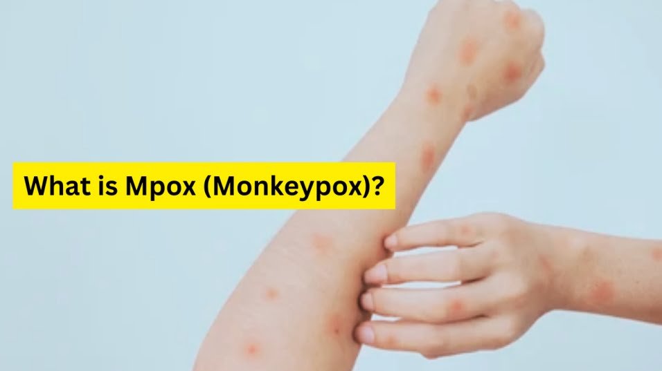 Mpox